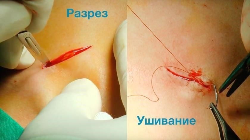 Ускорение заживления шрама после аппендэктомии